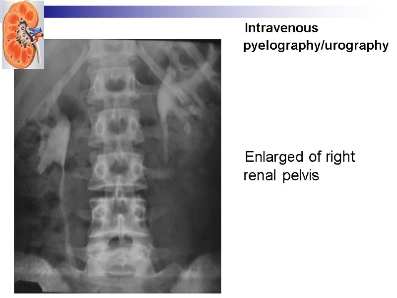 Intravenous pyelography/urography      Enlarged of right renal pelvis